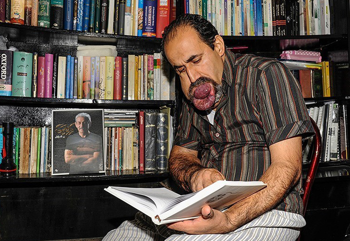 (تصاویر) بیماری دردناک اسماعیل (تصاویر) بیماری دردناک اسماعیل