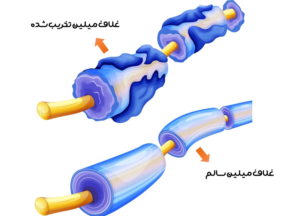 تفاوت غلاف میلین سالم و تخریب شده دو تصویر از تفاوت غلاف میلین سالم و تخریب شده