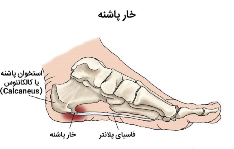 هرآنچه درباره خار پاشنه پا باید بدانید