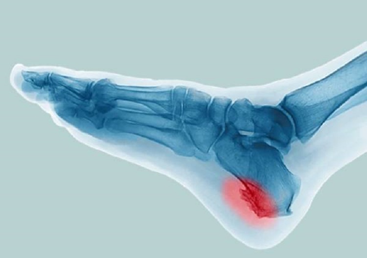 هرآنچه درباره خار پاشنه پا باید بدانید