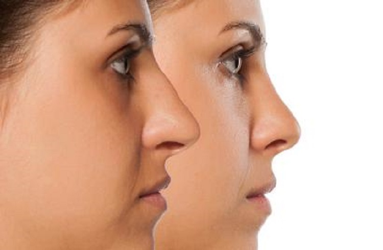 جراحی زیبایی بینی جراحی زیبایی بینی و هرآنچه در این خصوص باید بدانید