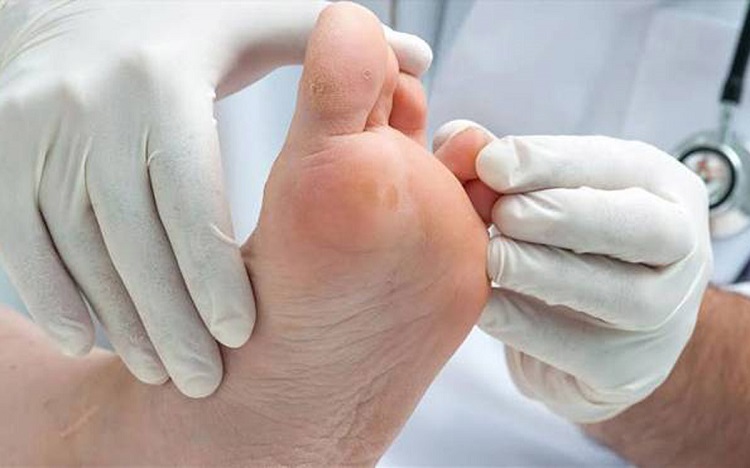 تشخیص زخم پای دیابیتی زخم پای دیابیتی؛ علل، نشانهها و راههای درمان آن