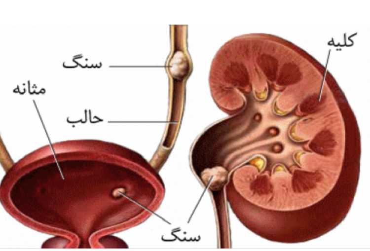 انواع مختلف سنگ کلیه سنگ کلیه؛ علل، نشانهها و راههای درمان و پیشگیری از آن