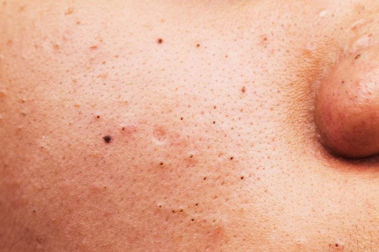 علت پوست چرب و عوارض آن پوست چرب و راههای مراقبت از آن