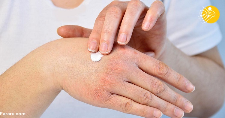 عوامل محرک پسوریازیس چیست؟ عوامل محرک پسوریازیس چیست؟
