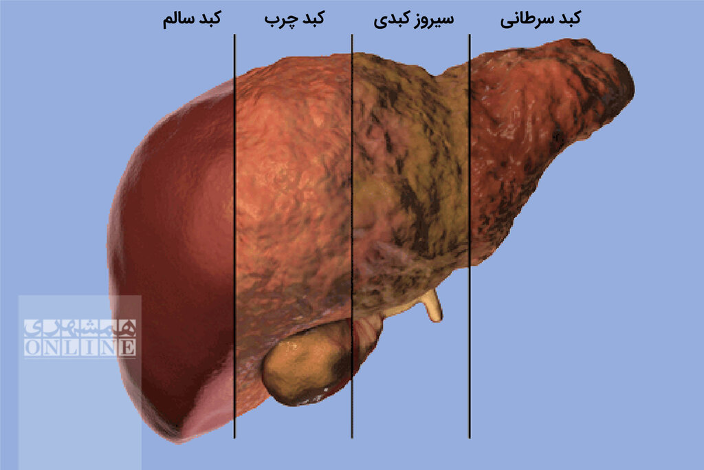 ۶ علامت چرب شدن کبد و یک نکته‌ طلایی