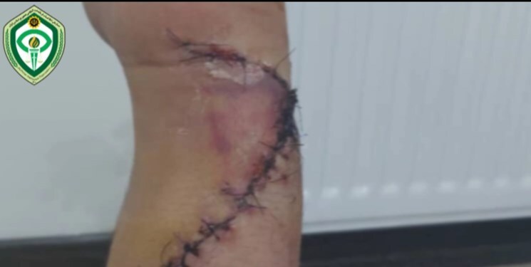 (تصاویر (۱۶+)) حمله خونین اراذل در بریانک؛ نقص عضو یک شهروند/دستی که پزشکان پیوند زدند