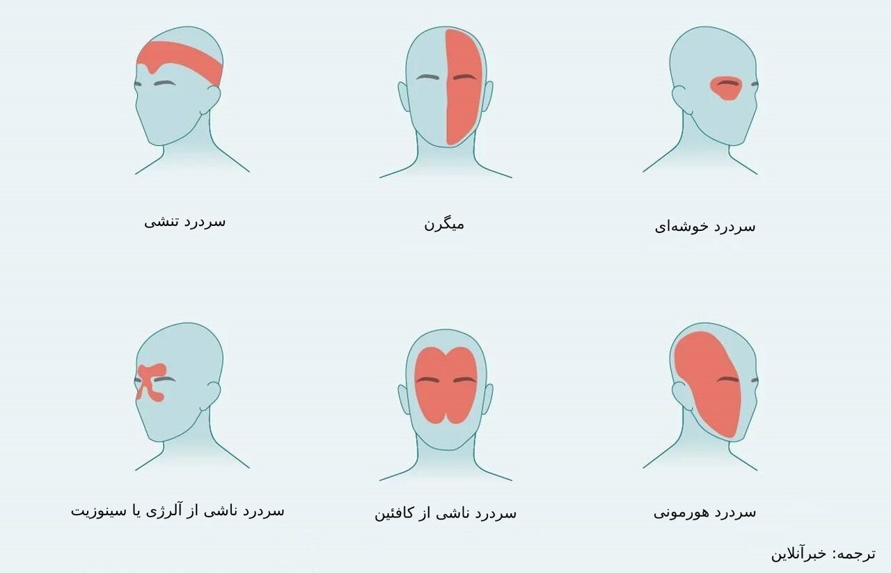 از کافئین تا فشار خون بالا؛ شایع‌ترین عوامل ایجاد سردرد
