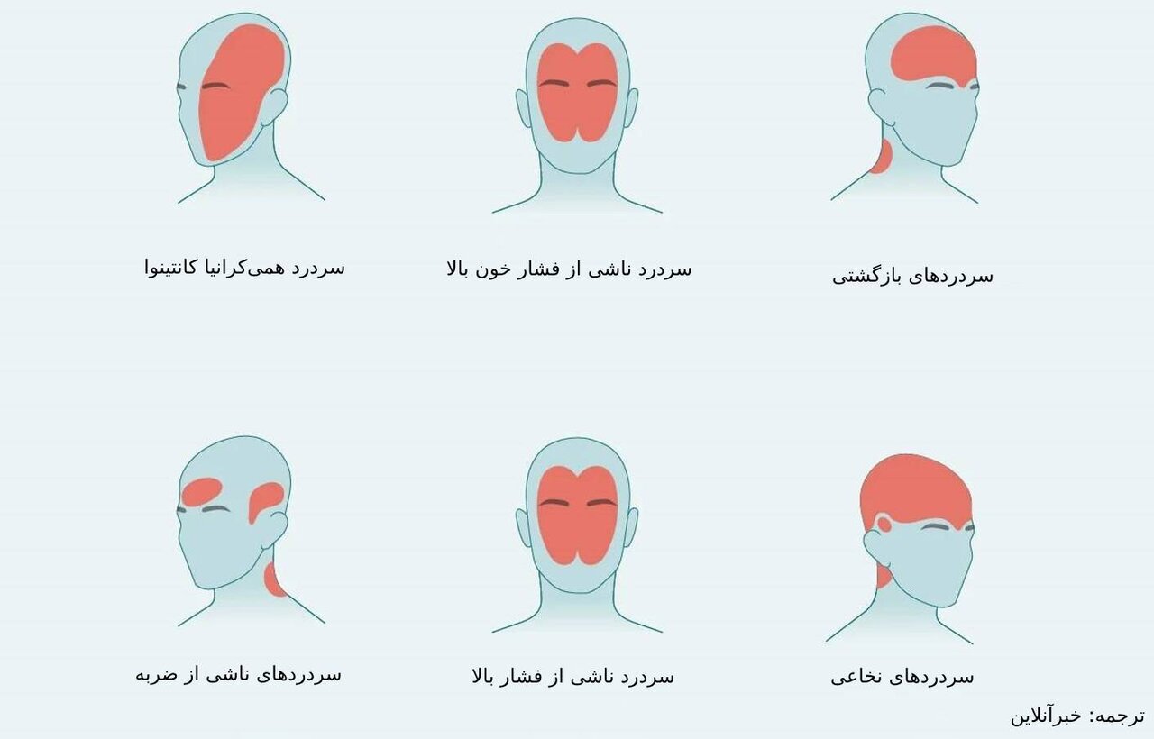 از کافئین تا فشار خون بالا؛ شایع‌ترین عوامل ایجاد سردرد