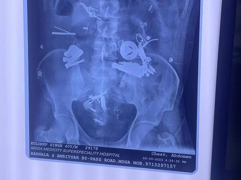 کشف ۱۵۰ شی از جمله دستبند و سمعک در شکم بیمار