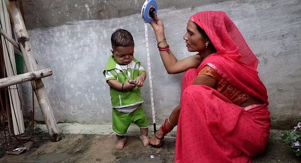 مرد ۶۰ سانتیمتری هندی که از ۵ سالگی دیگر رشد نکرد و تنها ۷ کیلو وزن دارد