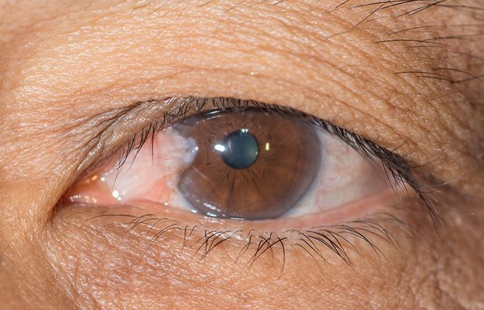 ناخنک چشم چیست؟ آیا روشی خانگی برای درمان ناخنک چشم وجود دارد؟