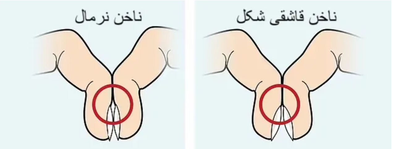 تشخیص سرطان ریه با یک تست ۵ ثانیه‌ای