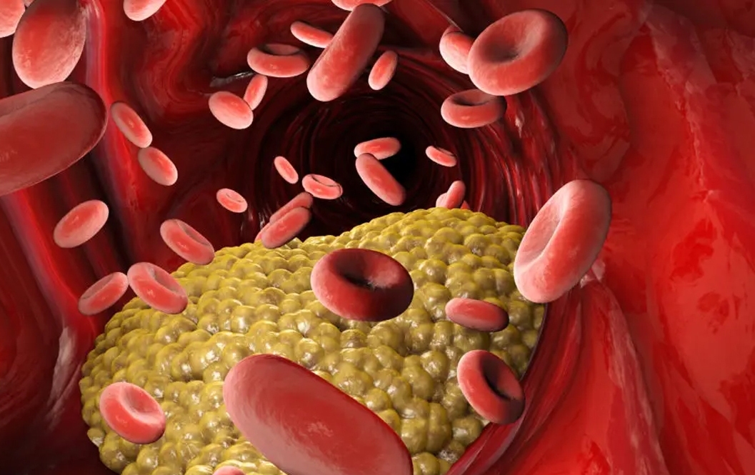 علائم و روش درمان تری گلیسیرید بالا