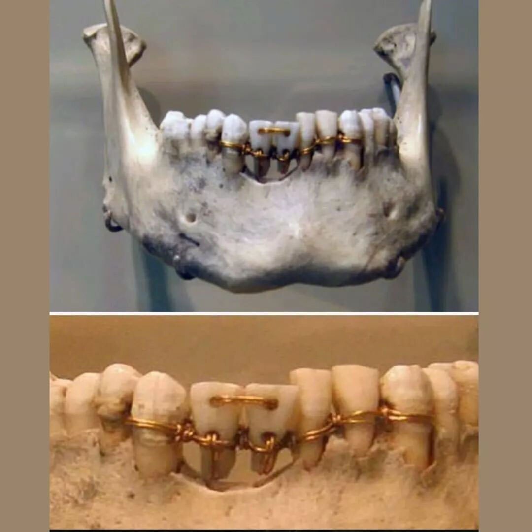 (تصاویر) کشف آثار دندانپزشکی روی مومیایی ۴۰۰۰ ساله!